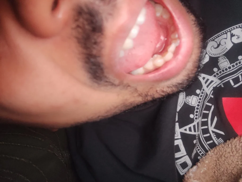 إنتفاخ داخلي للسنة أيسر