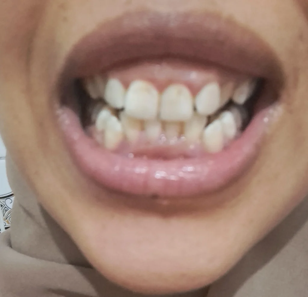 ابتسامة لثوية وبروح خفيف