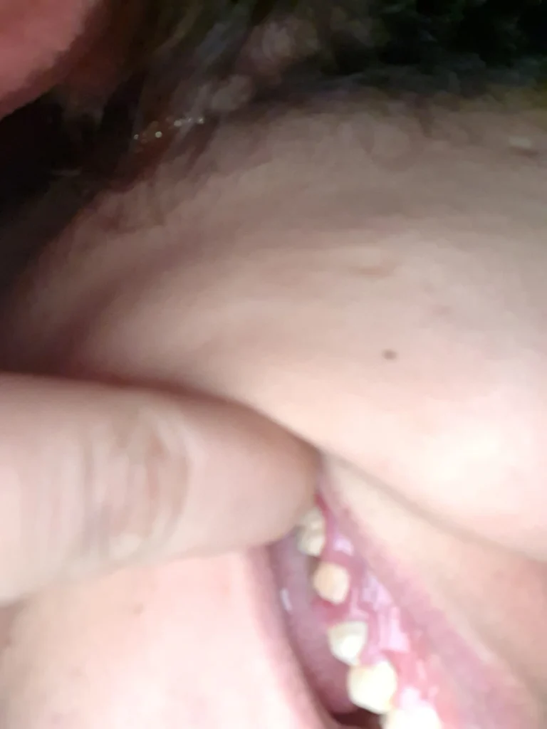 الم في الضرس العلوي مع بروز لحم وسط الضرس