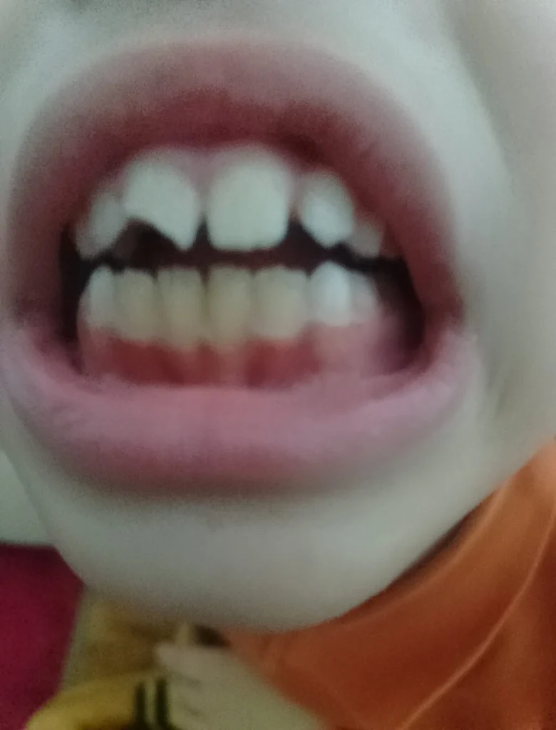 كسر السن الأمامي