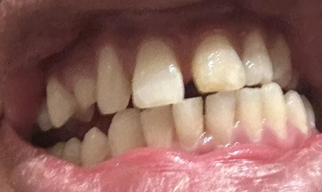 سن لبني ، و فرغات بين اسنان