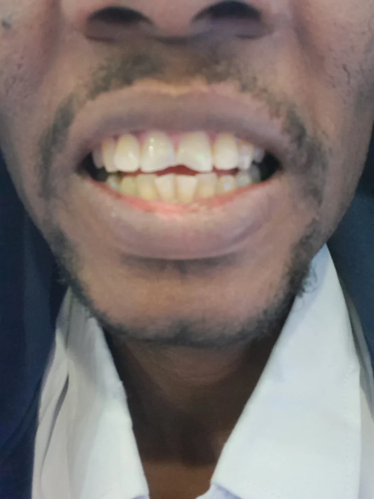 الاسنان الامامية