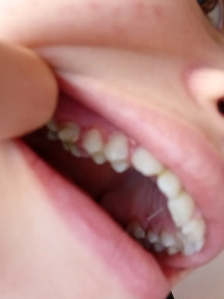 الم في الضرس العلوي الايمن