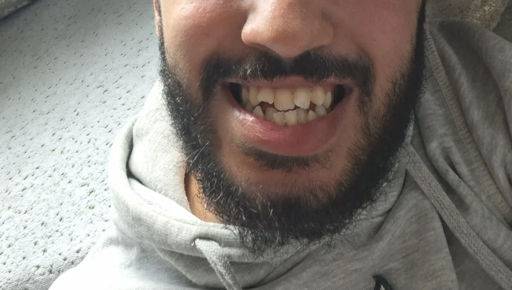 Estimation pour faire les bagues ou invisalligne