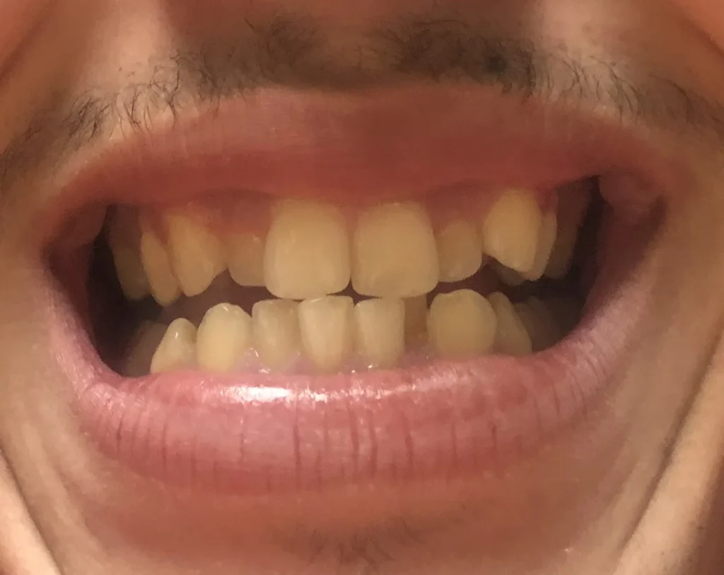 احتاج الى تقويم الاسنان