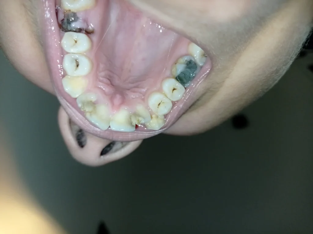 تسوس الأسنان