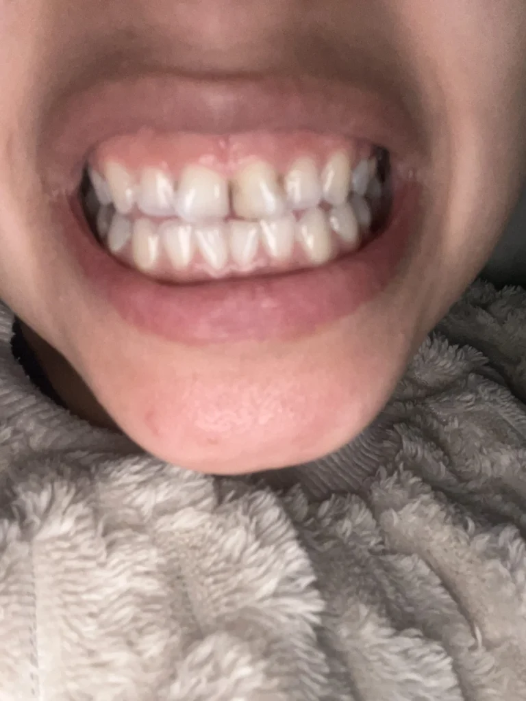 تسوس في الأسنان الامامية