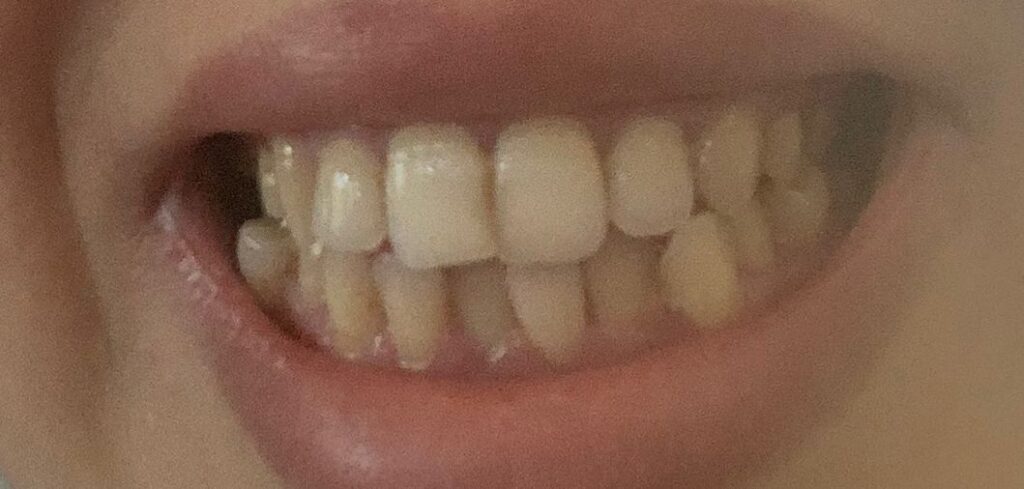 Elmehdi Tahiri – Oujda – Extraction