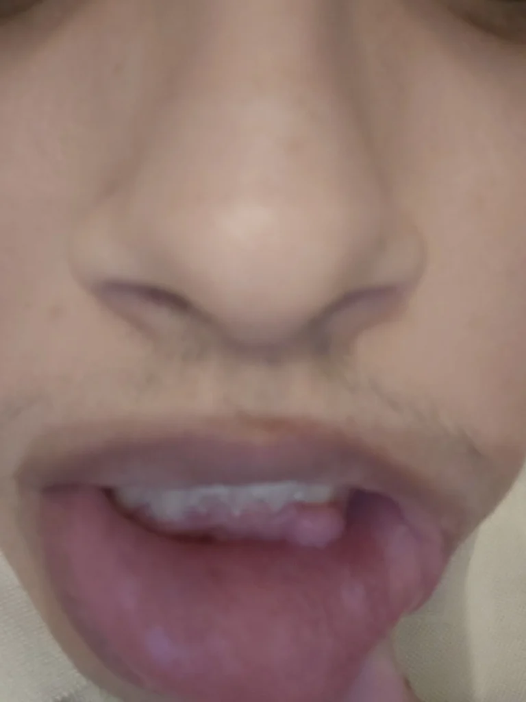 انتفاخ اللثة