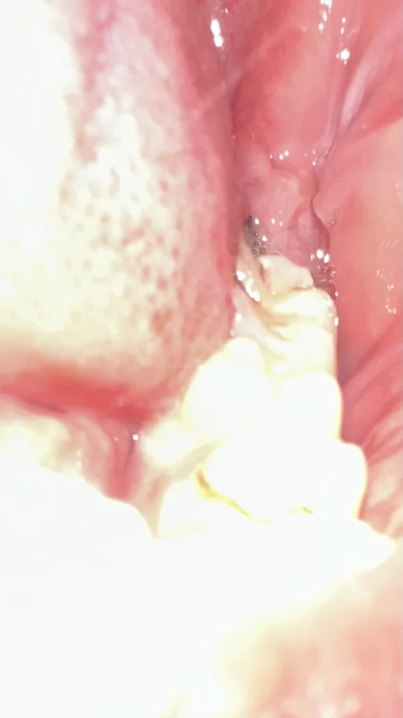 ضرس سفلي مكسور