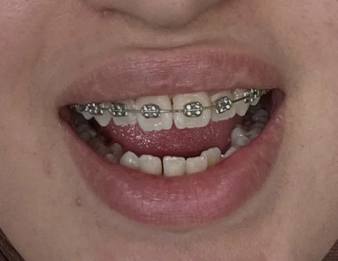 تقويم الأسنان