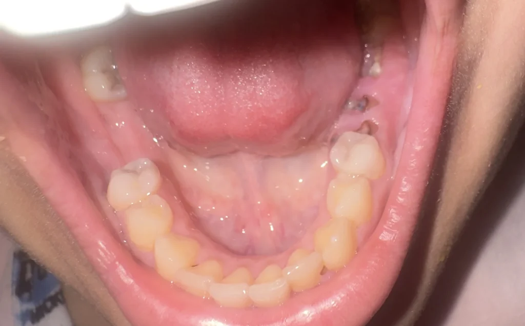 فراغات اضراس لا تزال الجذور موجودة