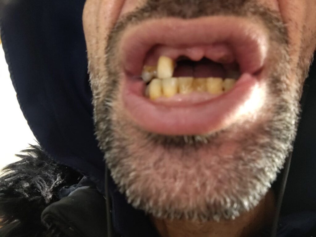 elmehdi tahiri – Oujda – Implant