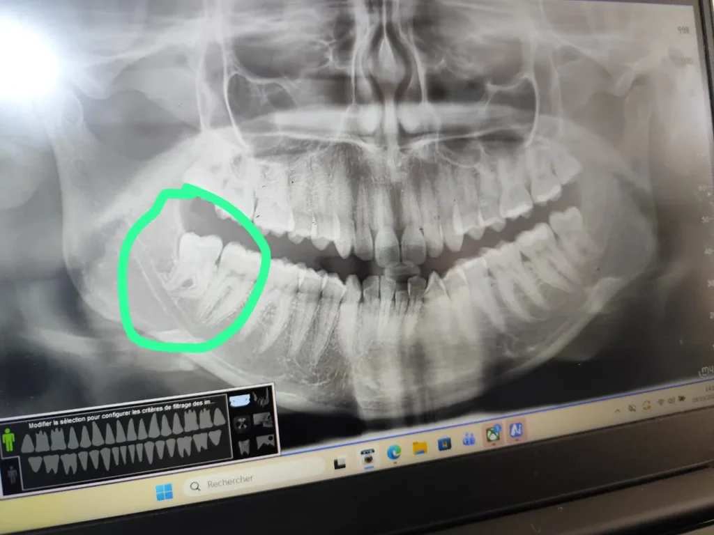 ضرسة العقل douleur