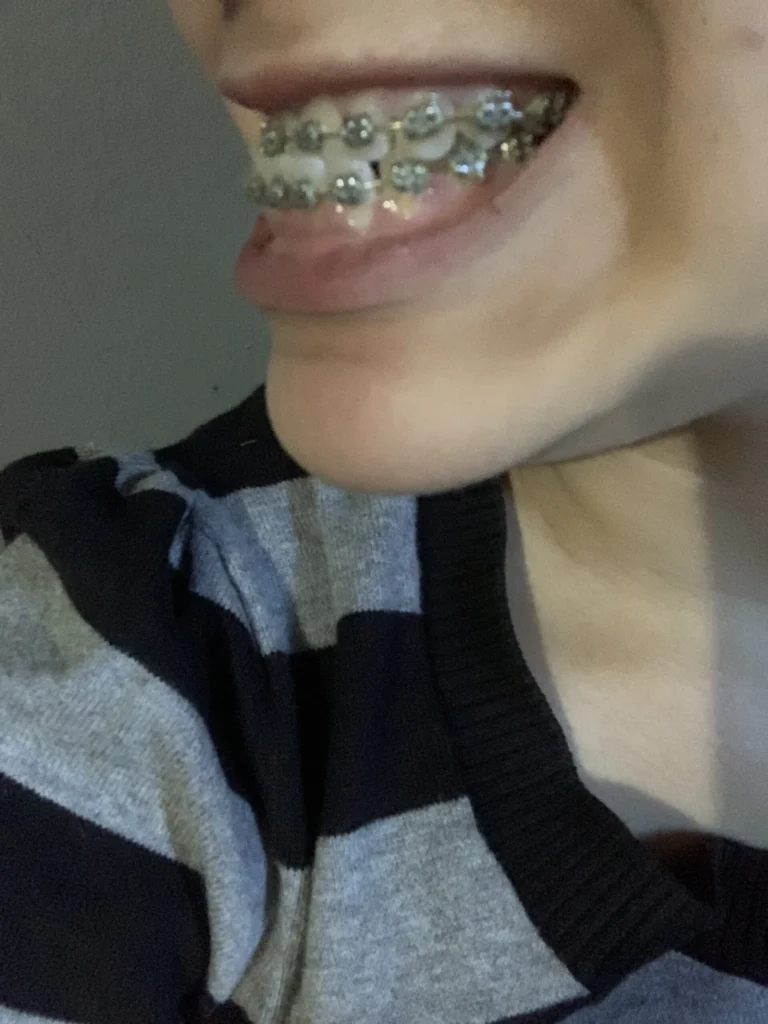 تقدم الأسنان السفلية