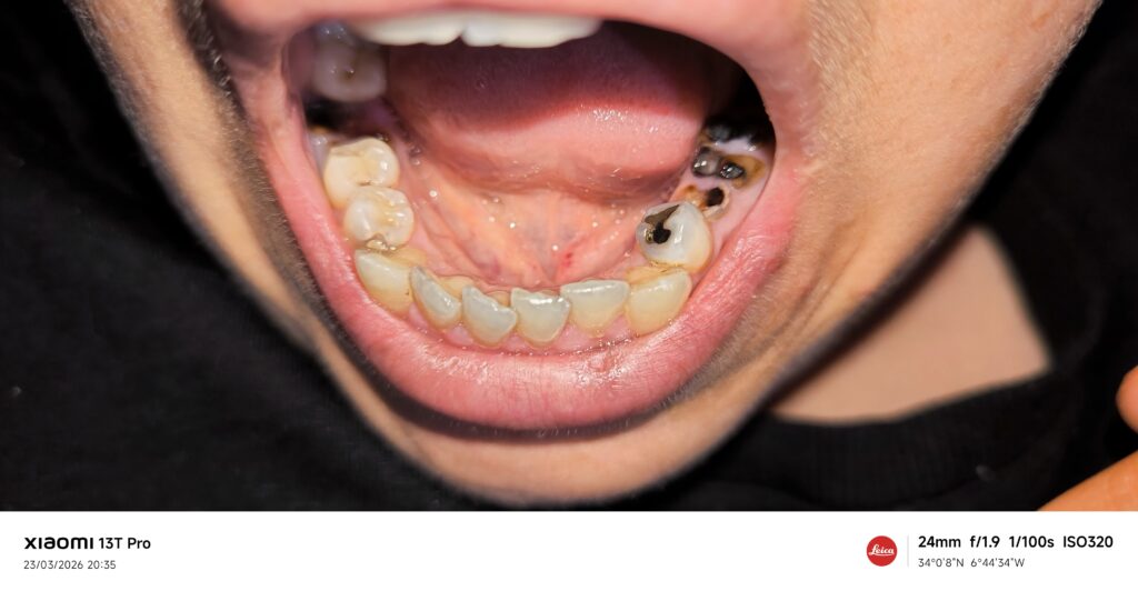 بسمة بسمة – Casablanca – Implant