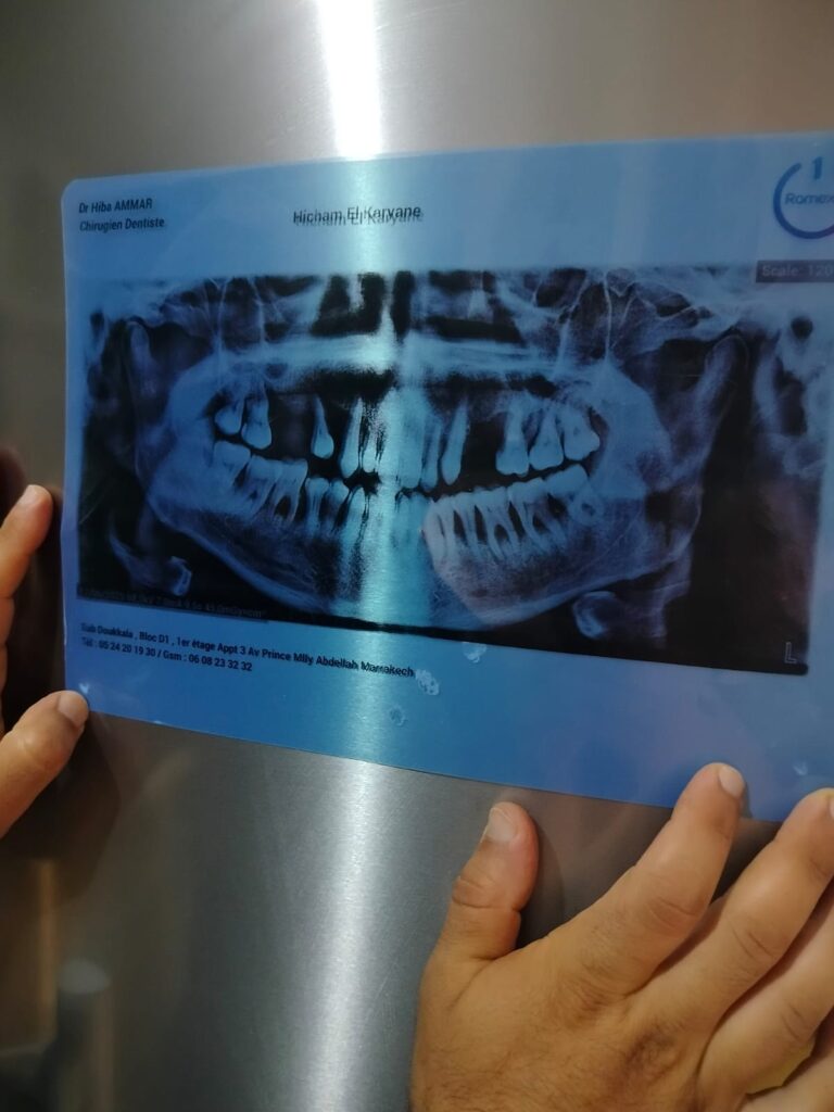 Hicham El karyane – Casablanca – Implant