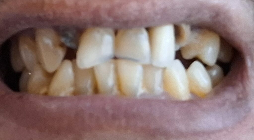 Issam amri – Rabat – Implant