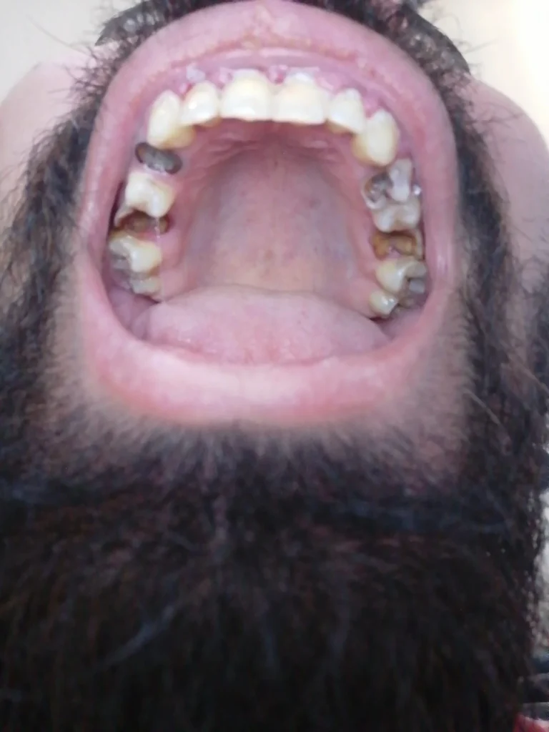 تسوس و مشاكل اللثة و جير الأسنان