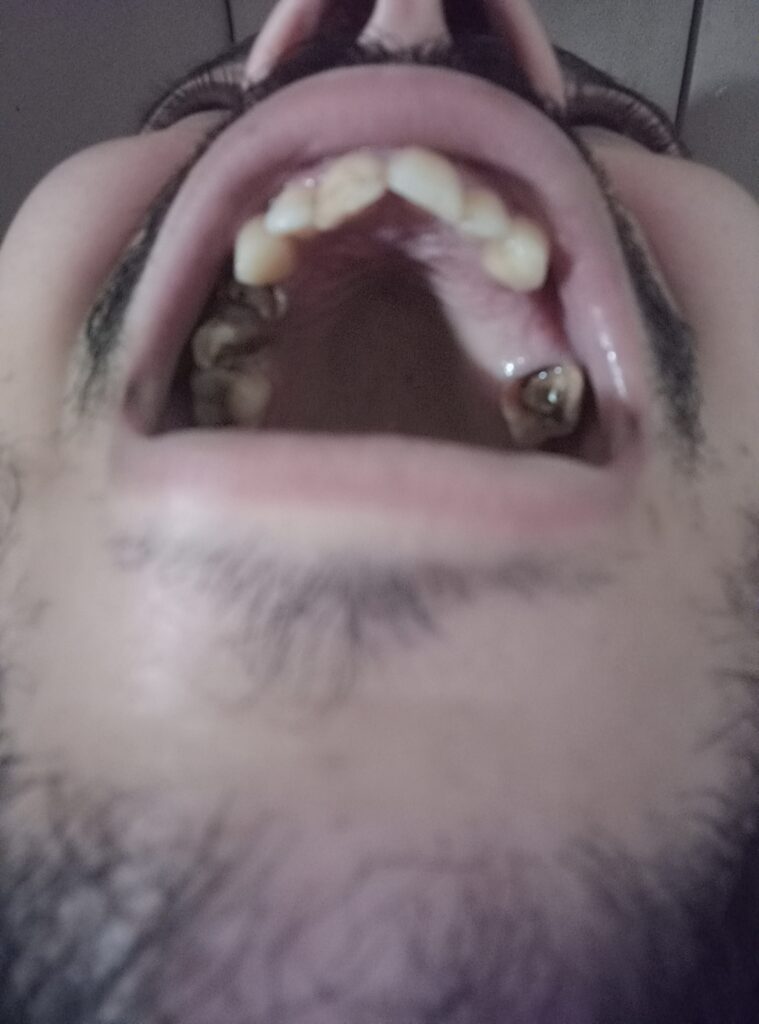 يونس وحامد – Casablanca – Prothèse fixe