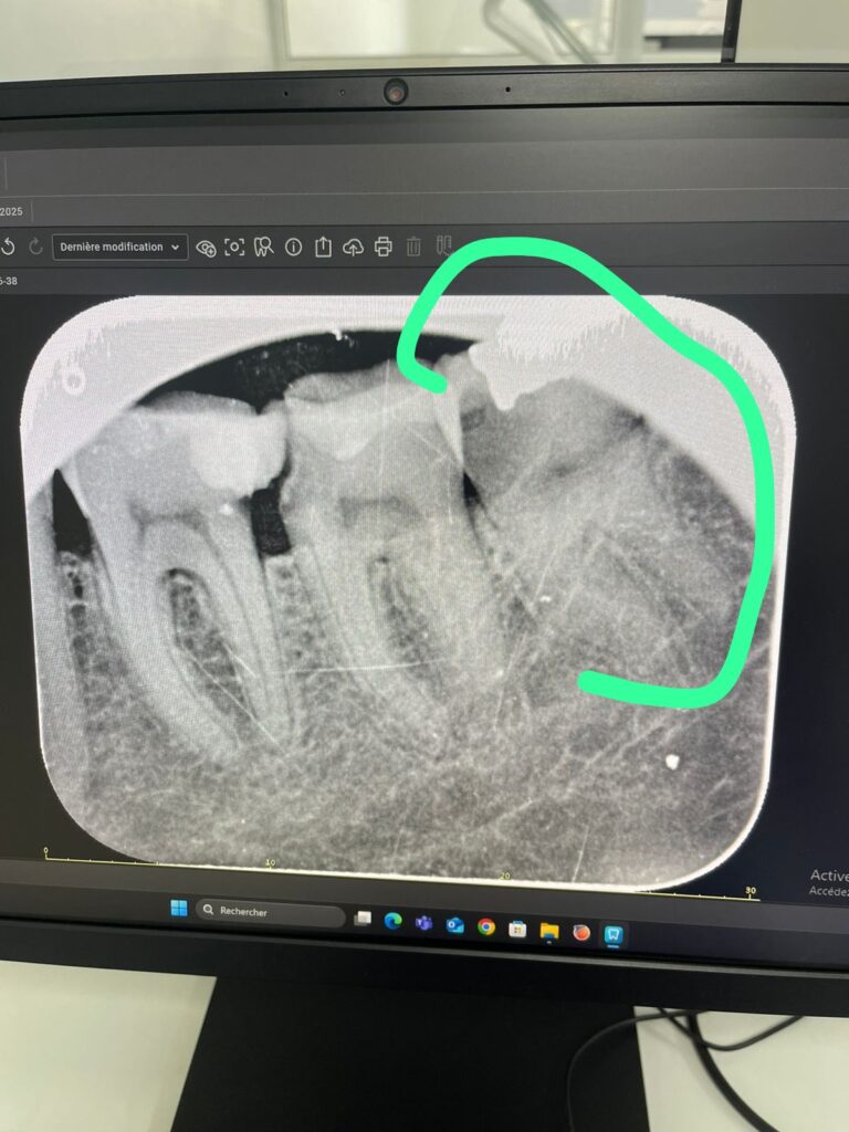 Mouaad Machhour – Casablanca – Dévitalisation