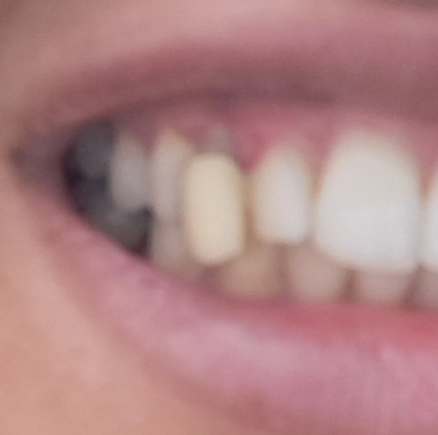 التقويم وعملية لاستخراج الناب