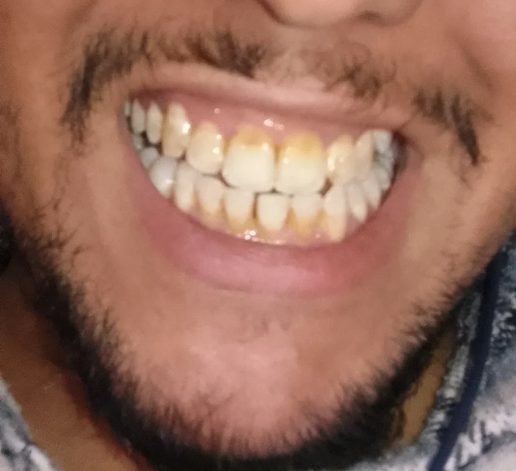 اصفرار لاسنان