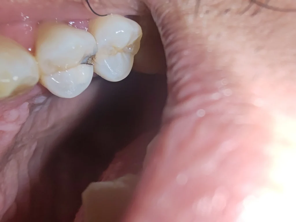 تسوس في الضرس العلوى الأيسر ، الضرس الثاني