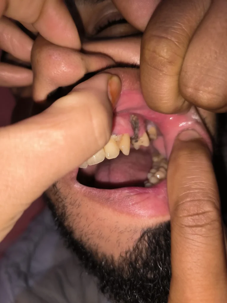 ألم في مكان خلع الضري الجهة اليسر الفك العلوي مع قرصات خفيفة تحت العين