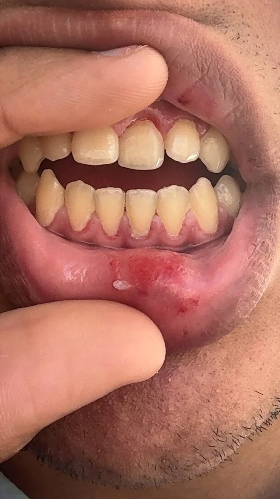 ما هو العلاج الذي يجب علي اتباعه