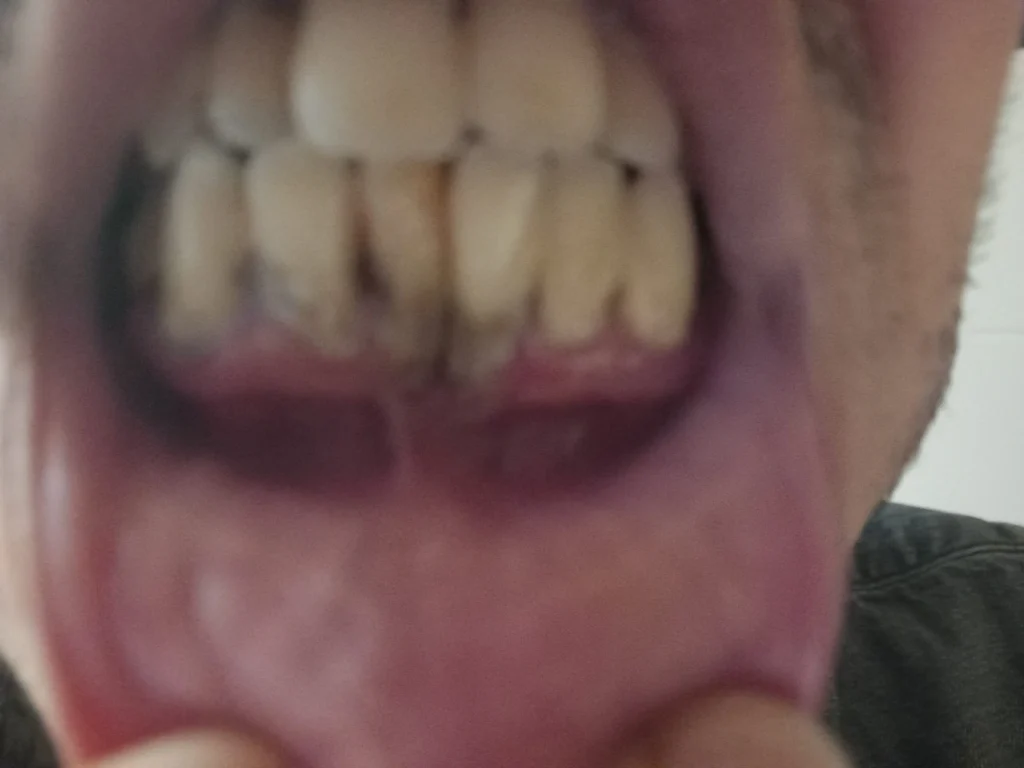 عندي جير فالاسنان وهرب ليا اللحم