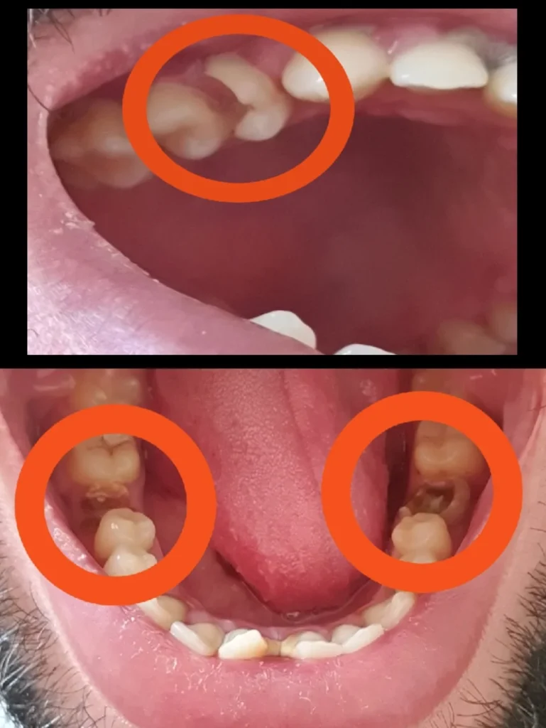 حشوي أسنان مكسرة